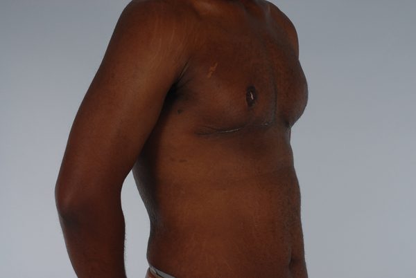 Gynecomastia