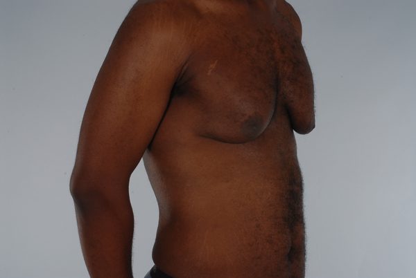 Gynecomastia Case 3020 Before Photo Gynecomastia