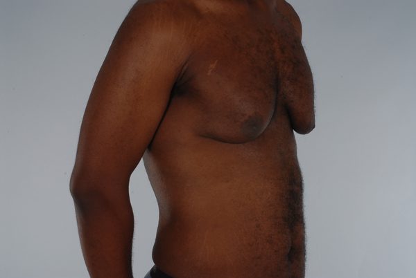 Gynecomastia