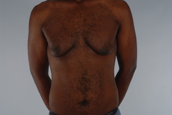 Gynecomastia Case 3020 Before Photo Gynecomastia