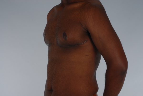 Gynecomastia Case 3020 After Photo Gynecomastia