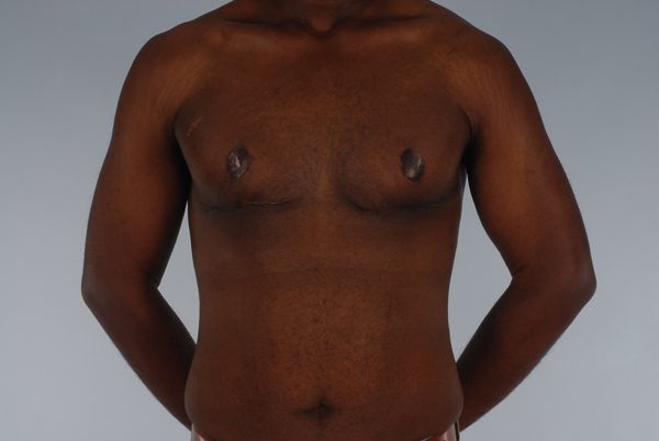 Gynecomastia Case 3020 After Photo Gynecomastia