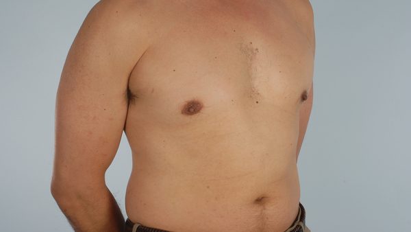 Gynecomastia Case 3030 After Photo Gynecomastia