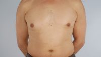 Gynecomastia