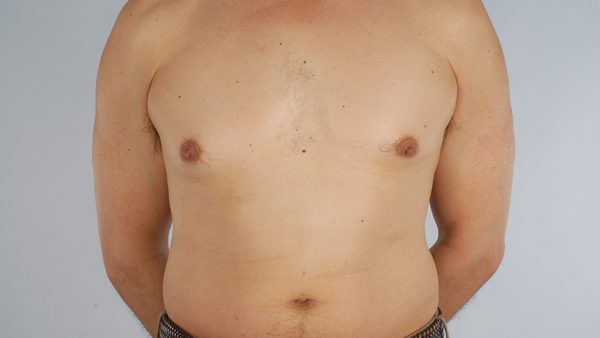 Gynecomastia Case 3030 Before Photo Gynecomastia