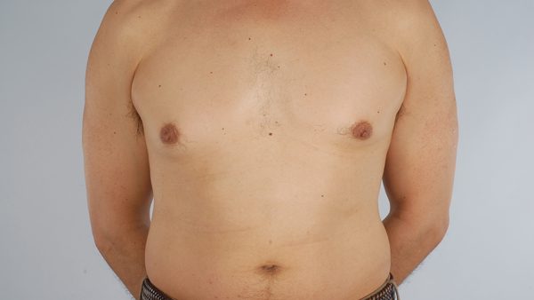 Gynecomastia