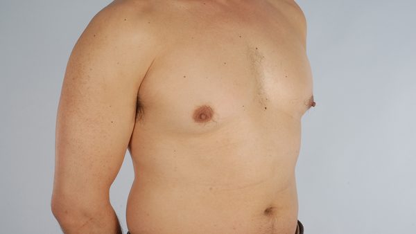 Gynecomastia Case 3030 Before Photo Gynecomastia