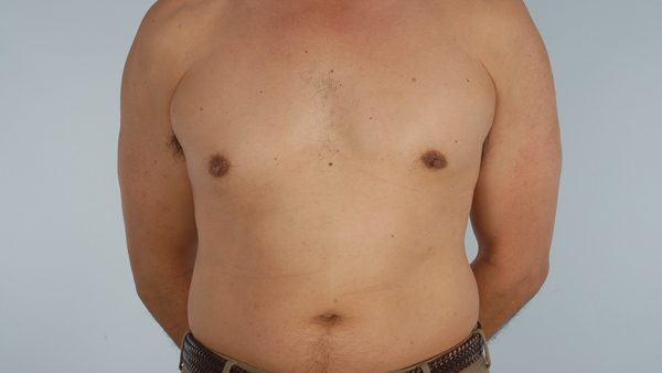 Gynecomastia Case 3030 After Photo Gynecomastia