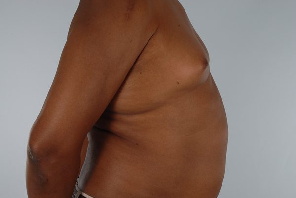 Gynecomastia Case 3038 Before Photo Gynecomastia