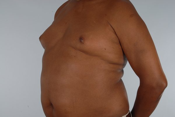 Gynecomastia