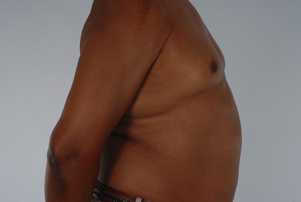 Gynecomastia Case 3038 After Photo Gynecomastia