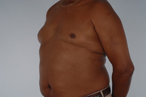 Gynecomastia