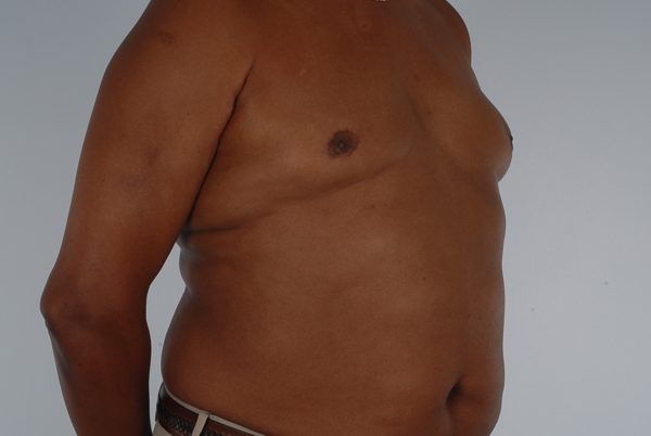 Gynecomastia