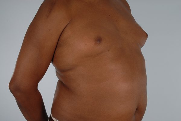 Gynecomastia Case 3038 Before Photo Gynecomastia