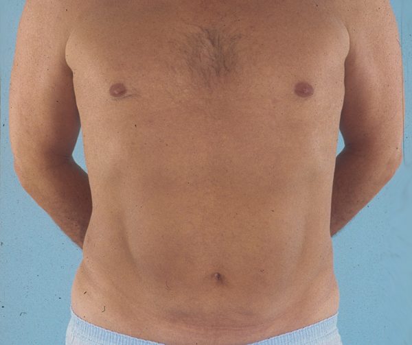 Abdominoplasty (Tummy Tuck)