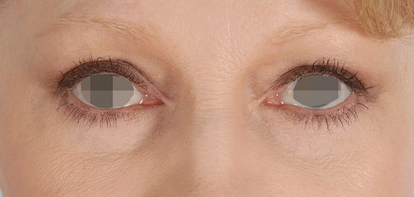 Eye lift