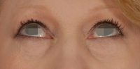 Eye lift