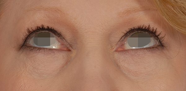 Eye lift