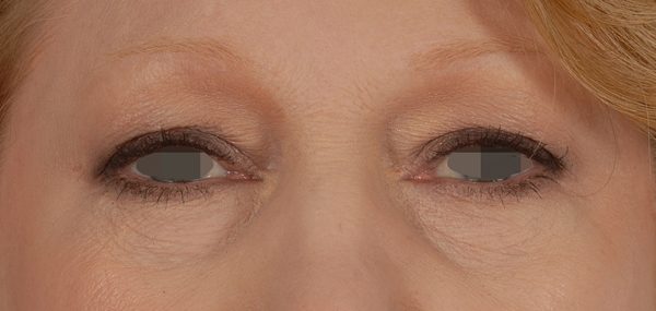 Eye lift