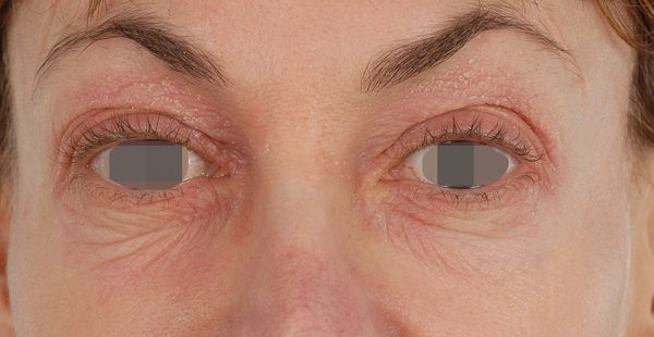 Eye lift Case 3070 Before Photo Eye lift