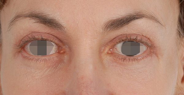 Eye lift Case 3070 After Photo Eye lift
