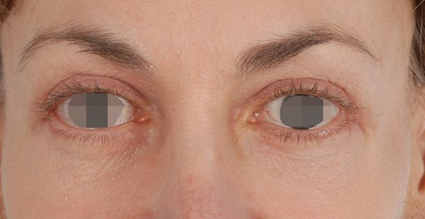 Eye lift