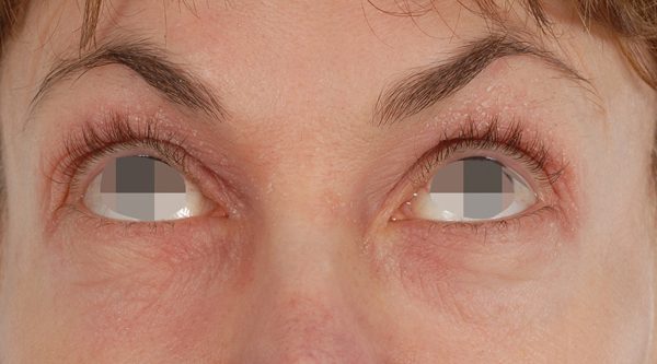 Eye lift Case 3070 Before Photo Eye lift