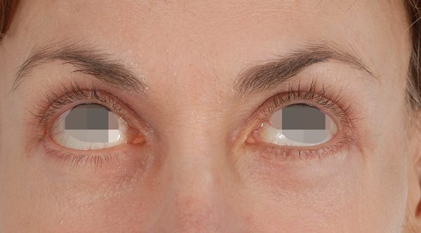 Eye lift Case 3070 After Photo Eye lift