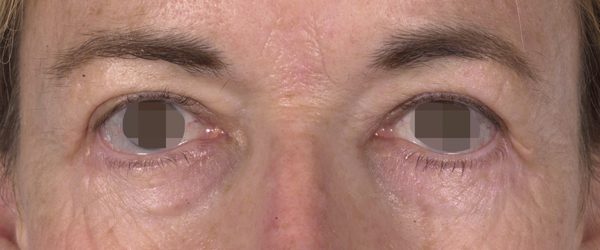 Eye lift Case 3082 After Photo Eye lift