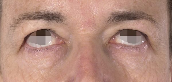 Eye lift Case 3082 Before Photo Eye lift