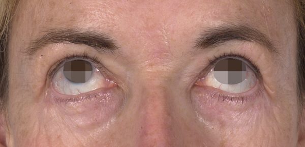 Eye lift Case 3082 After Photo Eye lift
