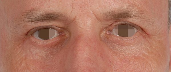 Eye lift Case 3088 After Photo Eye lift