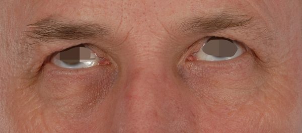 Eye lift Case 3088 Before Photo Eye lift
