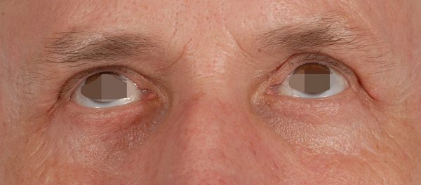 Eye lift Case 3088 After Photo Eye lift