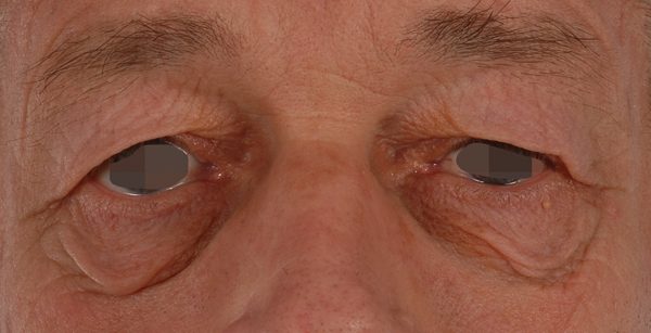 Eye lift Case 3098 Before Photo Eye lift