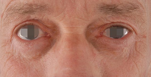 Eye lift Case 3098 After Photo Eye lift