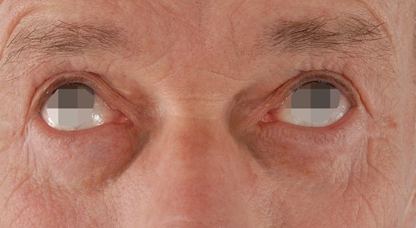 Eye lift Case 3098 After Photo Eye lift