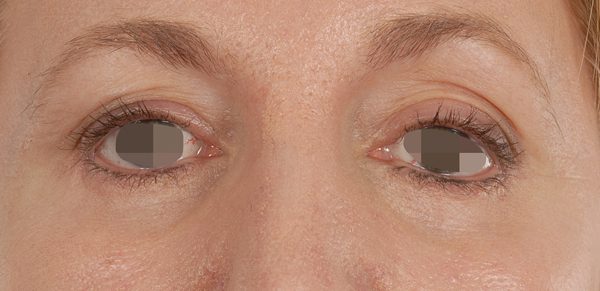 Eye lift