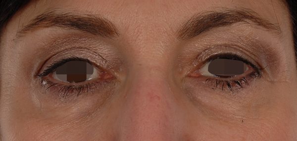 Eye lift Case 3110 Before Photo Eye lift