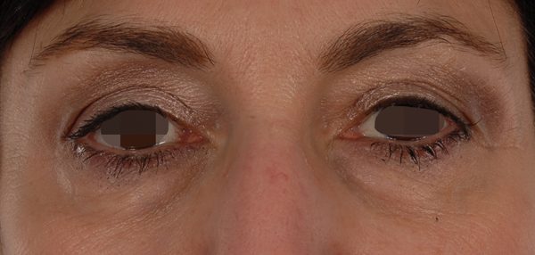 Eye lift