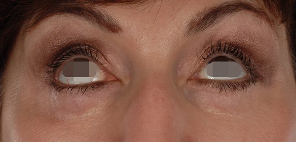 Eye lift Case 3110 After Photo Eye lift