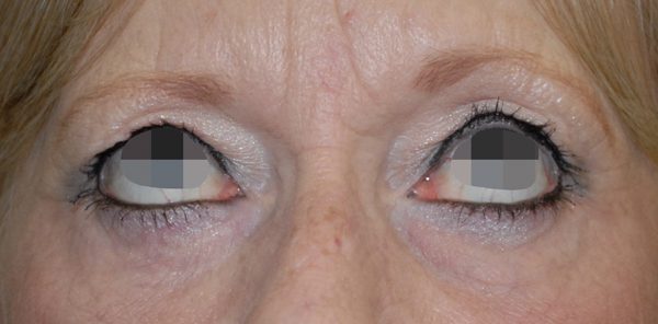 Eye lift