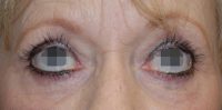 Eye lift