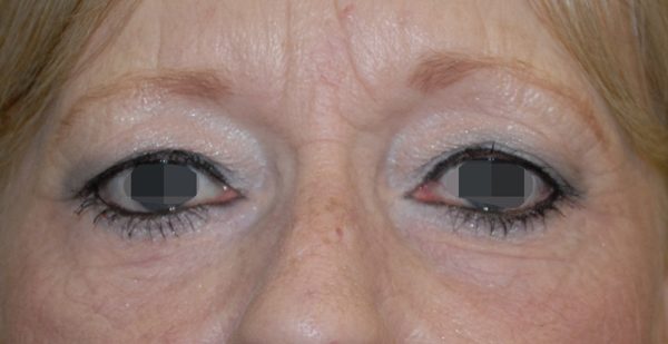 Eye lift