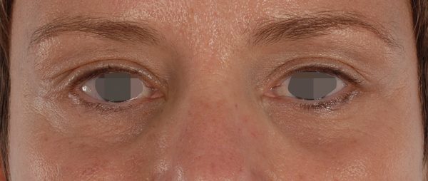 Eye lift Case 3122 After Photo Eye lift