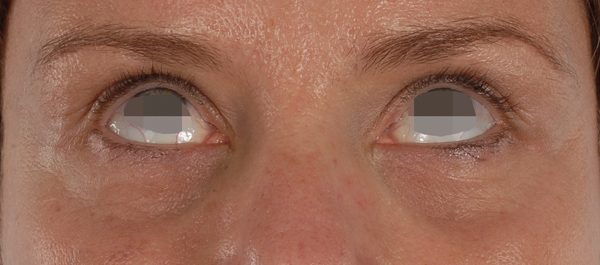 Eye lift Case 3122 After Photo Eye lift