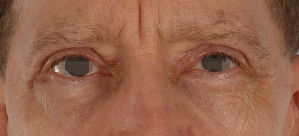 Eye lift Case 3132 After Photo Eye lift