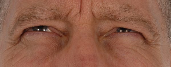 Eye lift Case 3132 Before Photo Eye lift