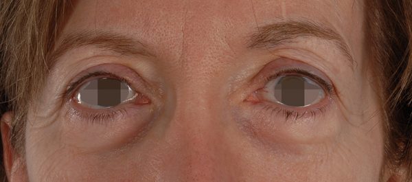 Eye lift Case 3138 Before Photo Eye lift