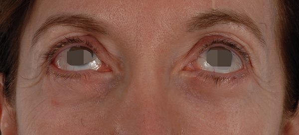 Eye lift Case 3138 After Photo Eye lift